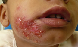 Impetigo. Klik op het plaatje voor een grote versie